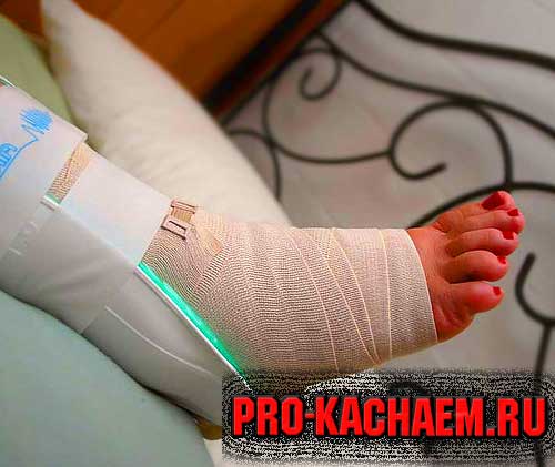 растяжение голеностопа